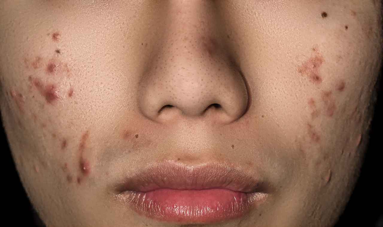 Con quali cibi combattere l'acne?