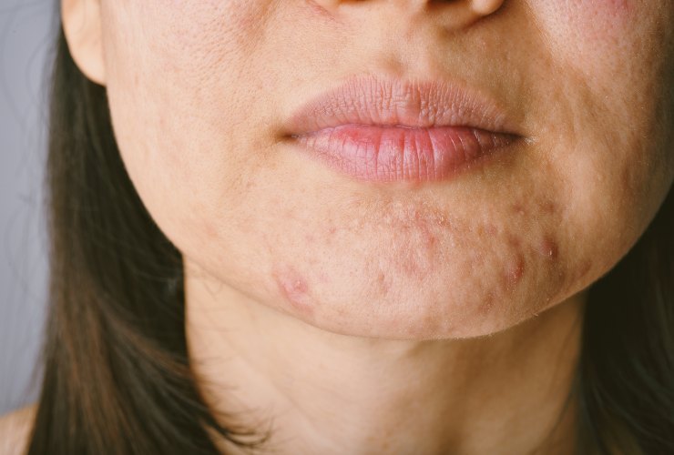 Con quali cibi combattere l'acne?